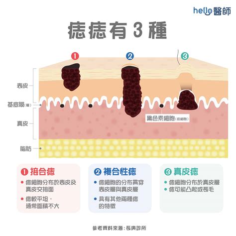 多痣的人|痣變大、痣多或長毛會變皮膚癌？認識痣的形成與原因